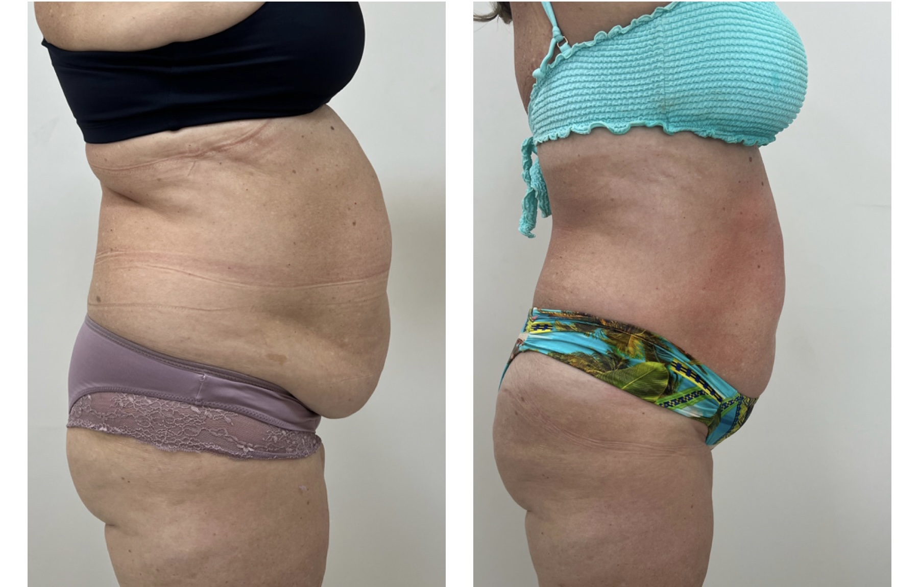 Registro de antes e depois de caso corporal autorizado