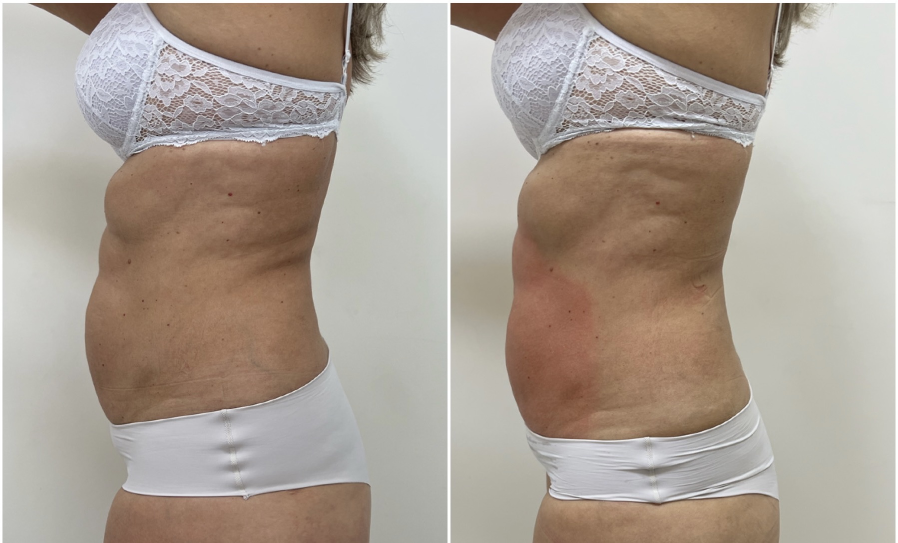 Registro de antes e depois de caso corporal autorizado